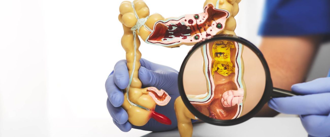 The Benefits of Colon Cleansing for Overall Well-being