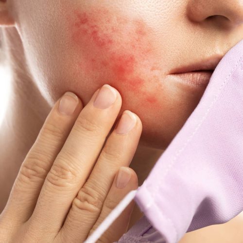 Understanding Rosacea: Causes, Symptoms, and Treatment
