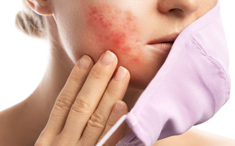 Understanding Rosacea: Causes, Symptoms, and Treatment